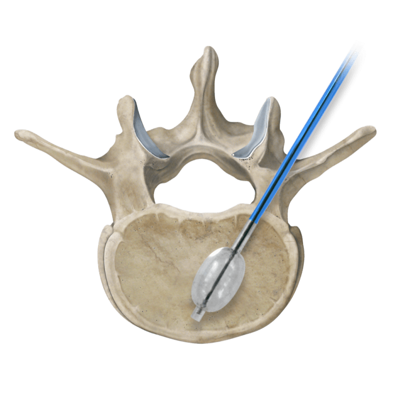 Osteo-Site Vertebral Balloon and Complex VCF Treatment Toolbox Launches