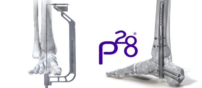 Phantom ActivCore Hindfoot Nail System Launches