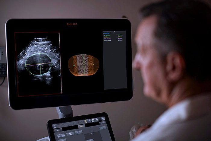 Philips Abdominal Aortic Aneruysm (AAA) Model Provides Physicians a More Patient Friendly Solution Compared to the Current Standard of Care for Managing AAA Patients