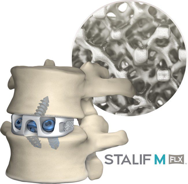 STALIF M FLX 3D-Printed ALIF Device Listed by SPINE Market Group as the Top ALIF 3D-printed Cage