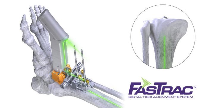 Paragon 28, Conducts the First Total Ankle Joint Replacement Surgery Utilizing Laser Alignment Technology