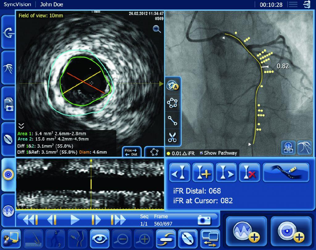 DEFINE GPS, study first patient enrolled