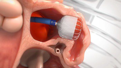 Boston Scientific, WATCHMAN FLX™