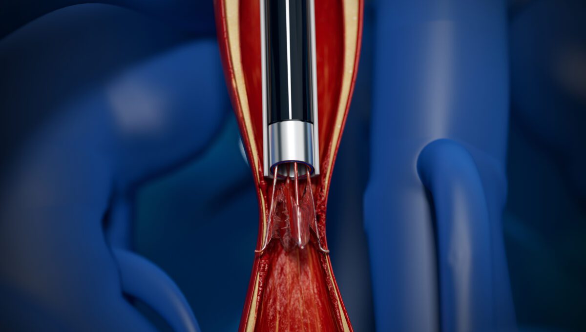 News IVC Filter Removal Laser Sheath - CavaClear