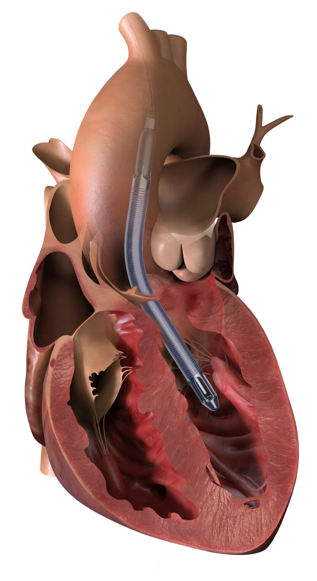 Impella 5.5 with SmartAssist