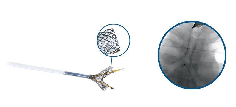 Y-shaped Tracheal Stent