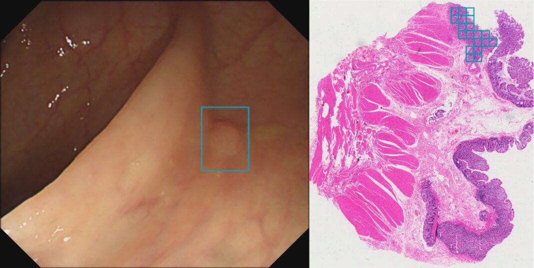 Wision AI Expands U.S. Offerings to Combat Colorectal Cancer With Multiple Screening Tools