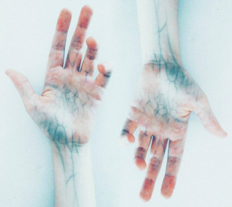What You Should Do if You're Suffering From A Vein Disease