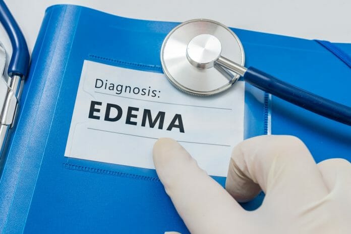 What Causes Edema?