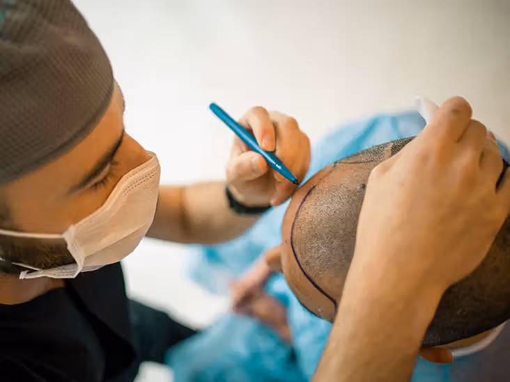 hair transplant