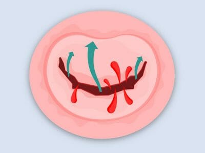 HeartValveSurgery.com