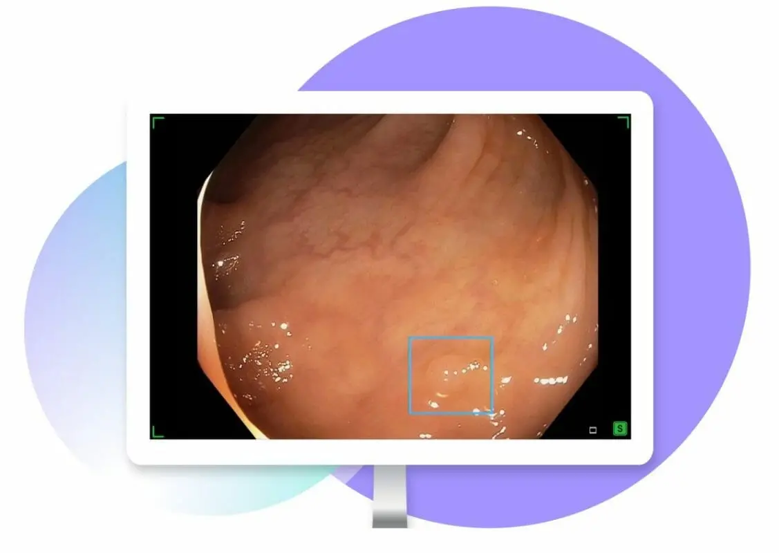 Iterative Health Announces Upcoming U.S. Availability of SKOUT®: Real-Time AI for Polyp Detection 8 Polyp Detection