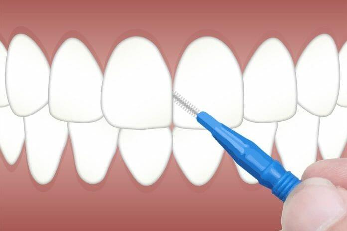 Dental Veneer Trends