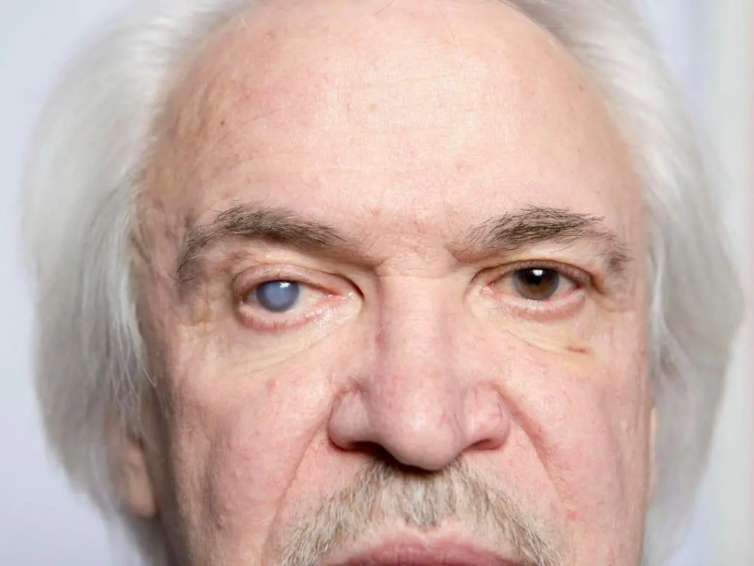 When Should You Get Cataract Surgery? 5 Cataract Surgery