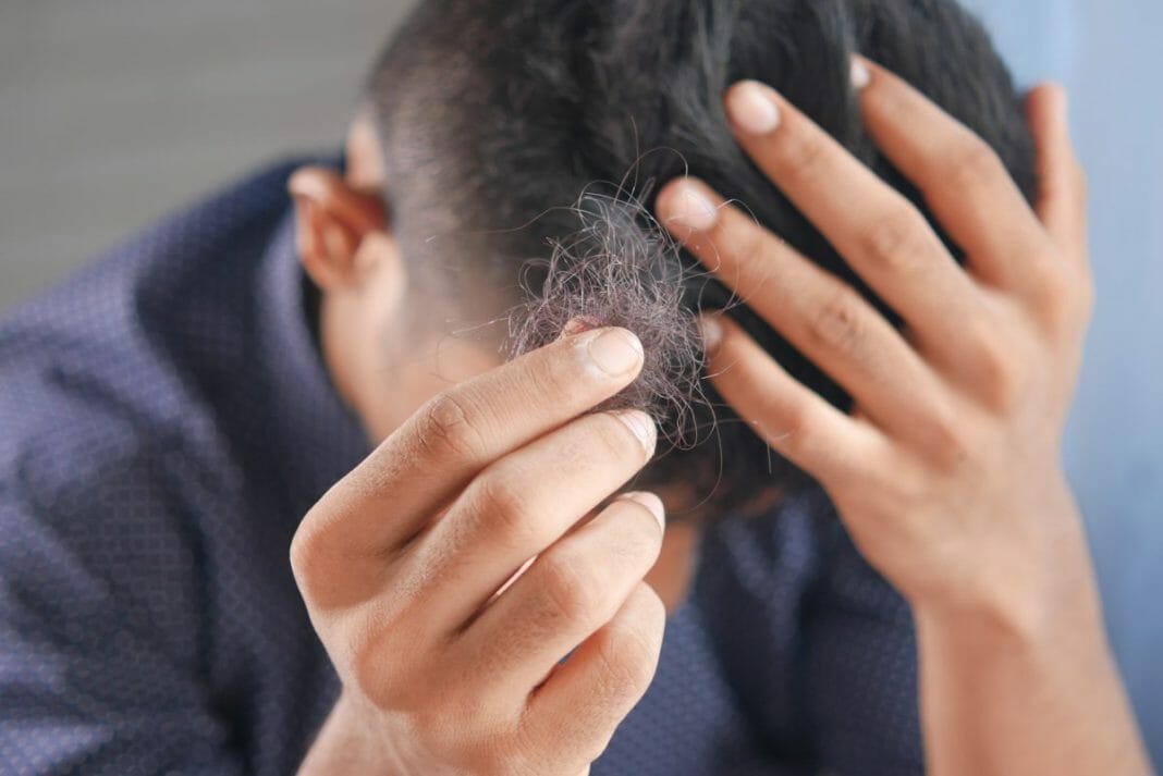 Prevent Hair Loss in Men