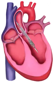 Magenta Medical
