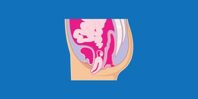 Pelvic Organ Prolapse | What All Women Need to Know According to INTIMINA