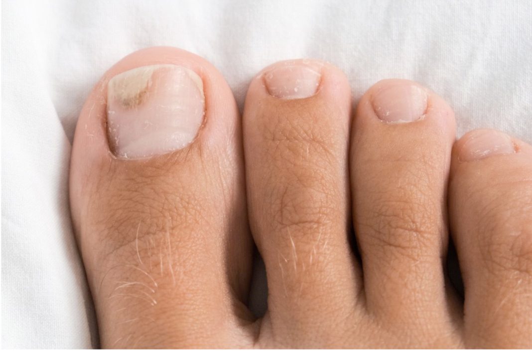 Nail Fungus