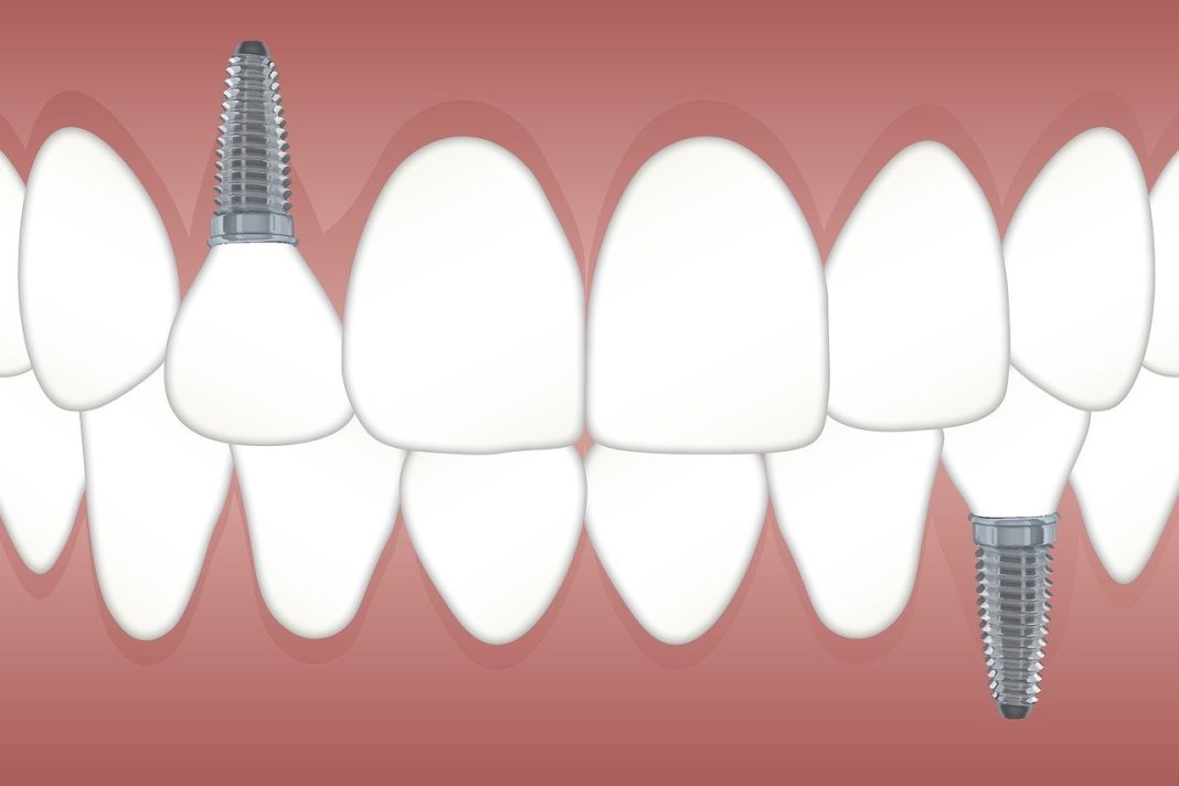 modern dental implants