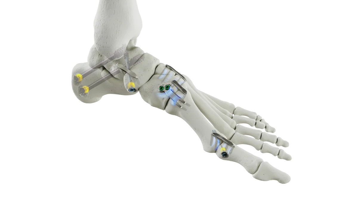 Medline Announces FDA Clearance for REFLEX HYBRID Nitinol Implants