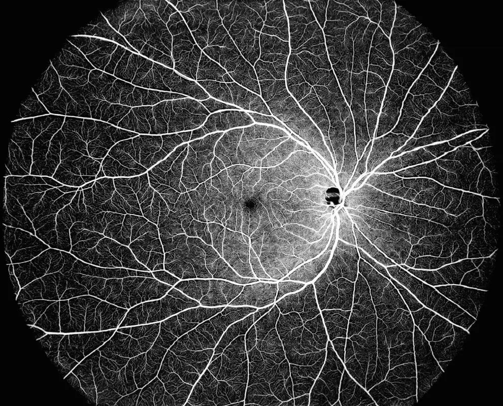 Intalight Receives CE Mark for Its Progressive DREAM OCT™ Swept Source Imaging