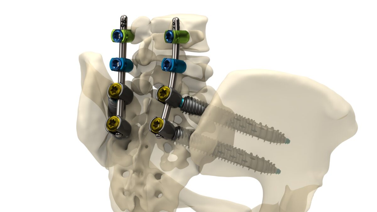 Genesys Spine Announces Launch of the SIros-X™ System for Sacroiliac Joint Fusion and Pelvic Fixation of Pedicle Screw Constructs