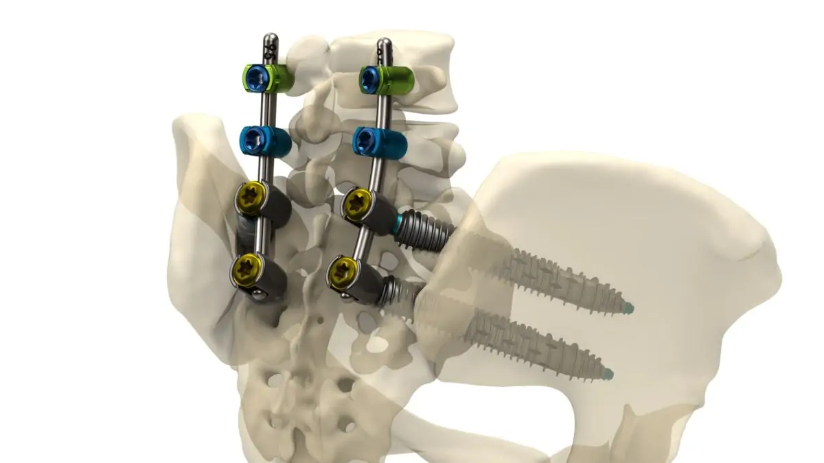Genesys Spine Announces Launch of the SIros-X™ System for Sacroiliac Joint Fusion and Pelvic Fixation of Pedicle Screw Constructs 1 Genesys Spine Announces Launch of the SIros-X™ System for Sacroiliac Joint Fusion and Pelvic Fixation of Pedicle Screw Constructs