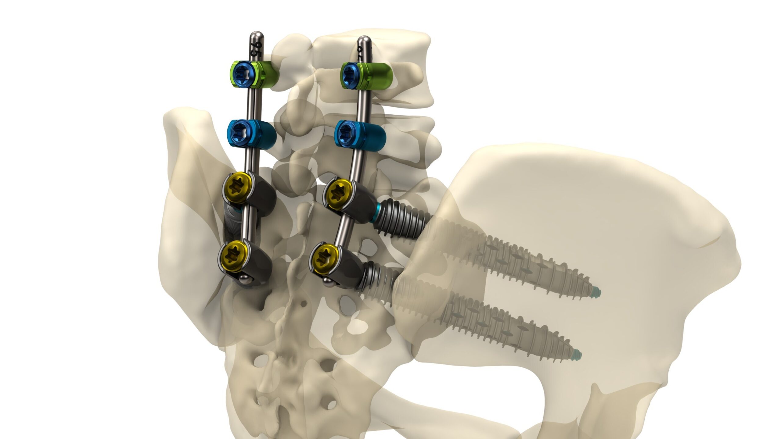 Genesys Spine Announces Launch of the SIros-X™ System for Sacroiliac Joint Fusion and Pelvic Fixation of Pedicle Screw Constructs