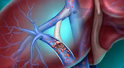 BD Delivers Next‑Generation TIPS Innovation to Advance Portal Hypertension Care Across the European Union 1 BD Delivers Next‑Generation TIPS Innovation to Advance Portal Hypertension Care Across the European Union